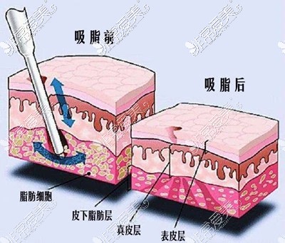 吸脂圖示