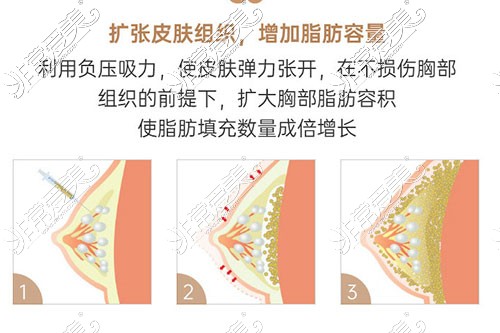 昆明正规丰胸医院是哪家 可以做脂肪隆胸吗多少价位