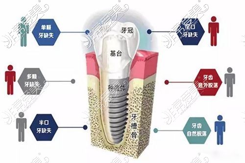 种植牙的组成