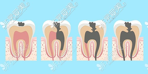 牙齿龋坏厉害示意图