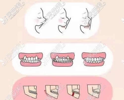 牙齿畸形对脸型的影响