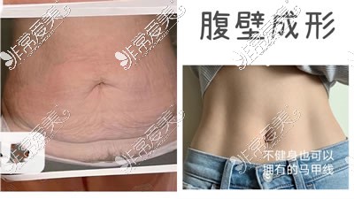西安崔鑫医生腹壁成形术打造马甲线