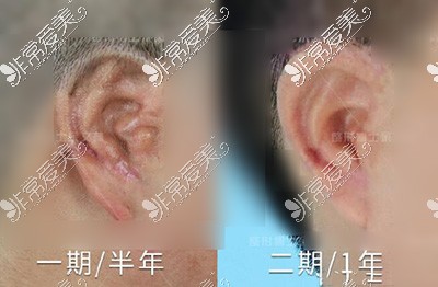 耳畸形一期手术改善半年展示