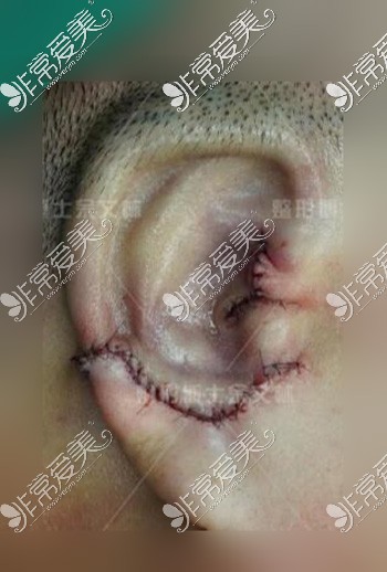 耳畸形改善术后耳朵形态