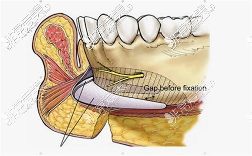 下巴假体植入示意图