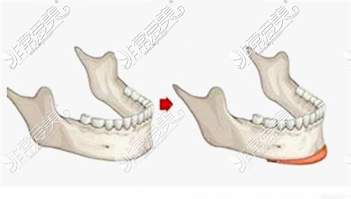 假体丰下巴示意图