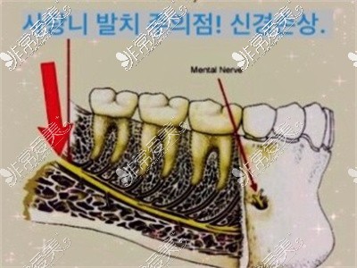 牙神经牙槽骨种植示意