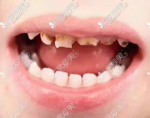 乳牙龋齿需要治疗吗