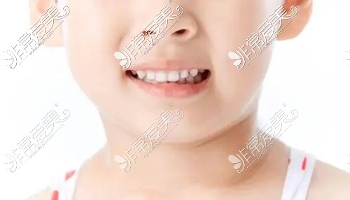儿童乳牙期有没有必要做牙齿矫正