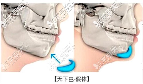 假體墊下巴放置位置及療效示意圖