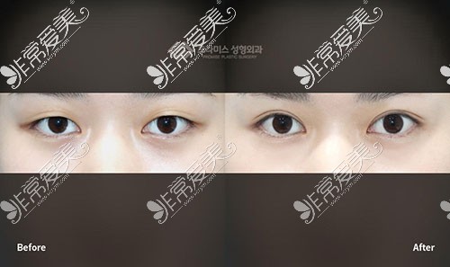 韩国普拉美斯整形做眼睛照片