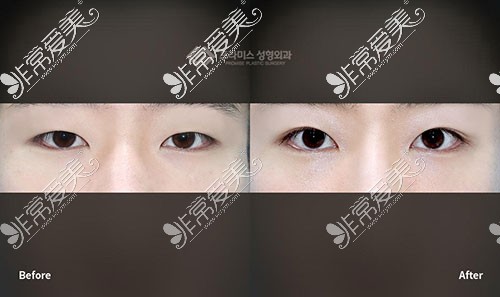 韩国普拉美斯做眼睛整形对比照片