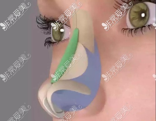 膨体隆鼻动画图3D展示