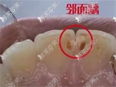 6岁儿童牙齿发黑烂掉怎么办？掉牙花钱又受罪妈妈直呼后悔