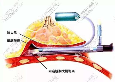 厦门内窥镜隆胸哪家好?不吹不黑这几家的医生比较厉害!