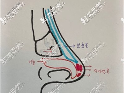 隆鼻假体放置剖析