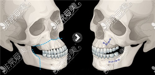 颌面整形手术动画图