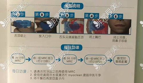 mrc早期肌功能矯正器使用說明