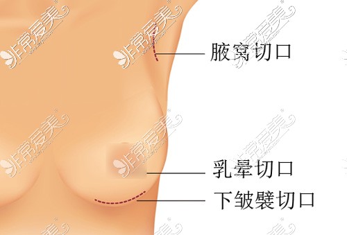 隆胸手术三种切口