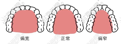 牙弓宽窄度图示
