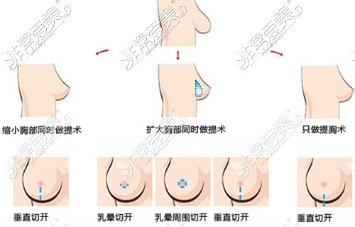 乳房下垂矫正治疗示意图