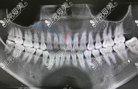 牙齿矫正术后CT图片展示