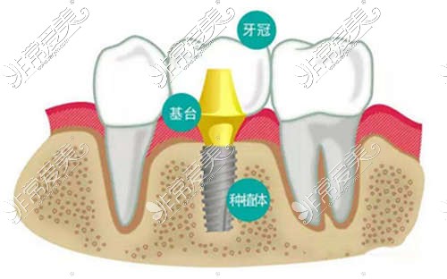 种植牙组成部分