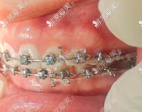 矫正牙齿过程图