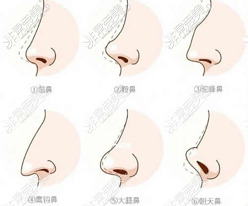 不同鼻型特点展示图