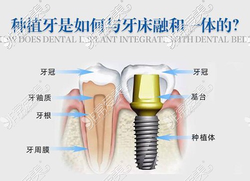 種植牙修復(fù)卡通圖展示照片