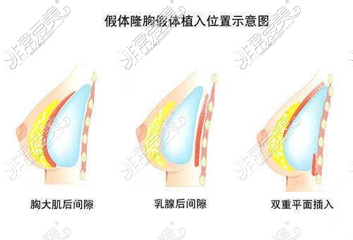 隆胸假体植入的位置