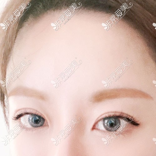韩国yellow双眼皮手术照片