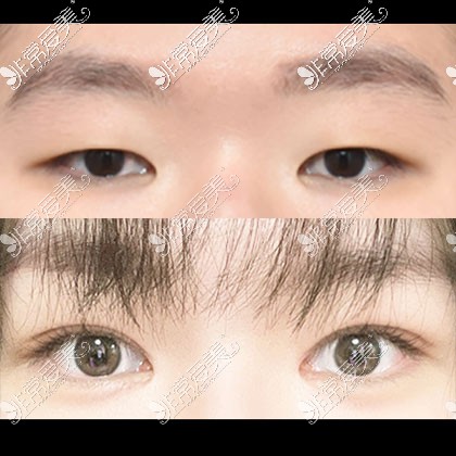 韩国icon双眼皮整形对比照