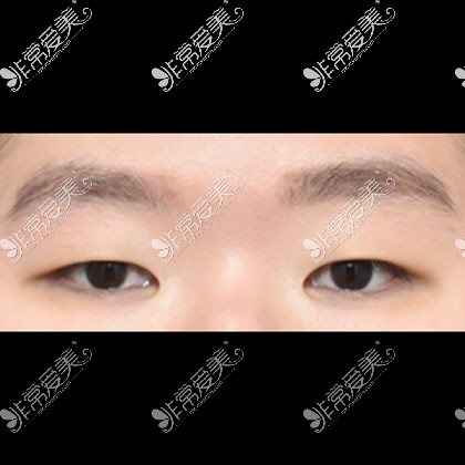 韩国icon双眼皮整形手术术前