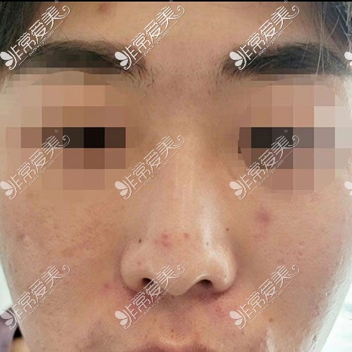 韩国现代美学隆鼻手术图片