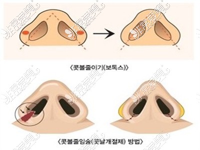 鼻综合手术鼻尖鼻翼位置改善