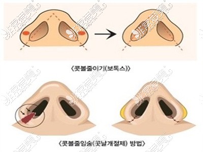 鼻綜合手術(shù)鼻尖鼻翼位置改善