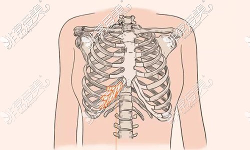 肋软骨选取位置