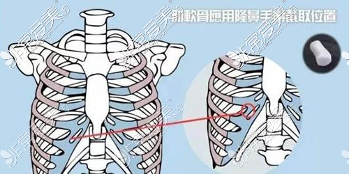 肋软骨选取位置