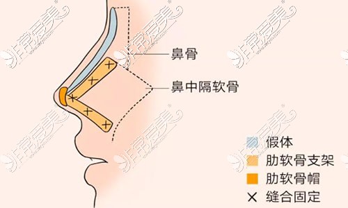 全肋骨隆鼻的利弊有哪些？多方位分析全肋骨隆鼻