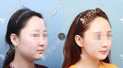 韩国snow脸部吸脂手术