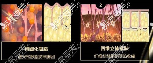 冯斌院长吸脂技术展示
