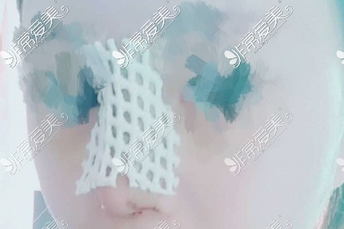 隆鼻术后鼻夹板作用