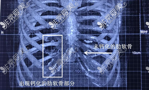 肋软骨钙化图示