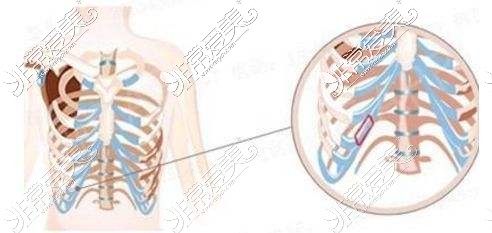 什么人不适合做肋骨鼻?肋软骨再好不适合也白搭!