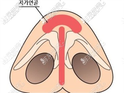 鼻头修复结构