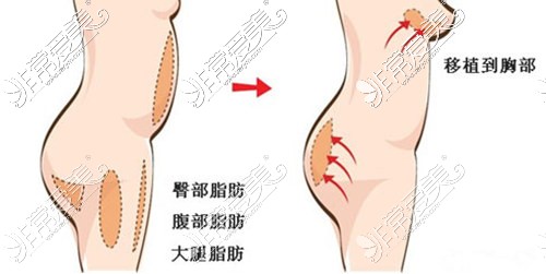 自體脂肪豐胸示意圖