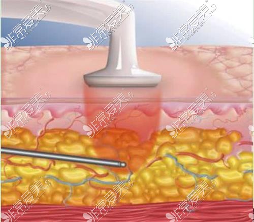 水动力吸脂术示意图