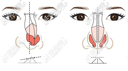 歪鼻和正常鼻子平面示意图对比