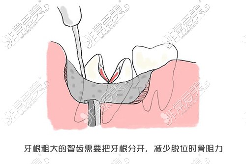 拔智齿图示